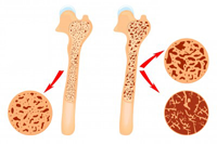 骨粗しょう症イメージ